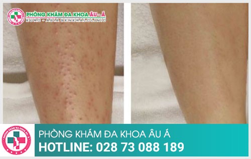 Nguyên nhân bệnh dày sừng nang lông là gì?