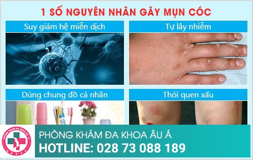 Nguyên nhân gây mụn cóc