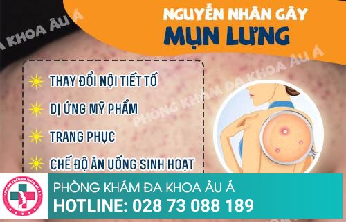 Nguyên nhân và cách trị mụn lưng hiệu quả