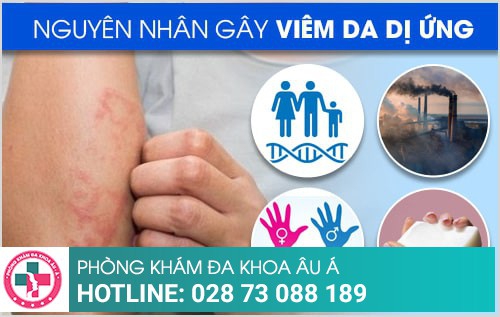 Viêm da dị ứng là gì? Cách điều trị bệnh hiệu quả