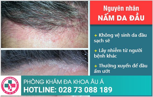 Nấm da đầu cách trị tốt nhất và hiệu quả