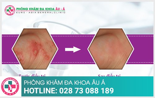 Những điều cần biết về bệnh ghẻ phỏng