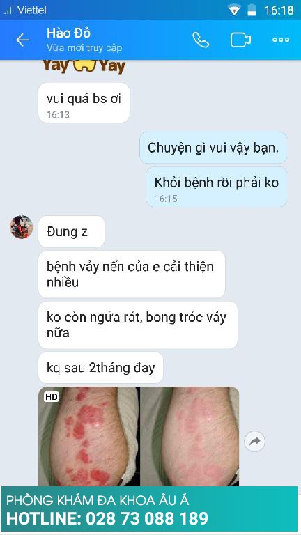 bệnh vảy nến