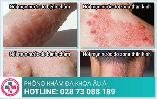 nổi mụn nước