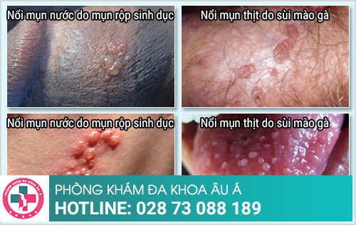 nổi mụn nước 