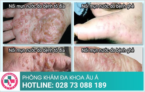 nổi mụn nước
