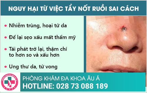 tẩy nốt ruồi