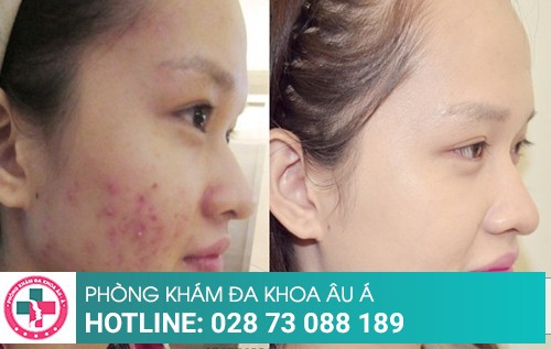 Phương pháp điều trị mẩn đỏ ngứa nhanh khỏi