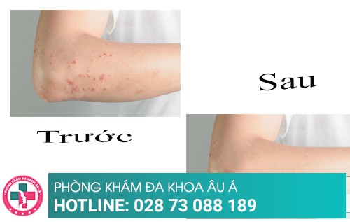 Phương pháp điều trị mẩn đỏ ngứa nhanh khỏi