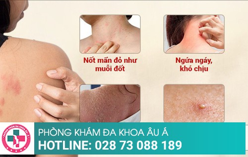 Phương pháp điều trị mẩn đỏ ngứa nhanh khỏi