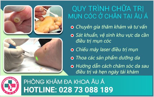 cách điều trị mụn cóc ở chân