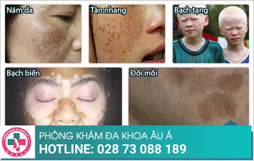 cách trị rối loạn sắc tố da