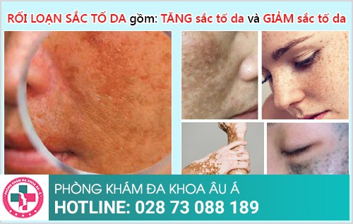 cách trị rối loạn sắc tố da