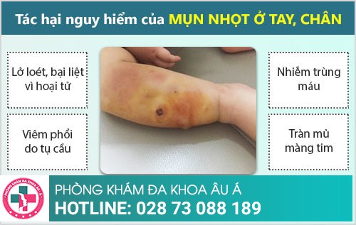 Dấu hiệu bị mụn nhọt tay, chân