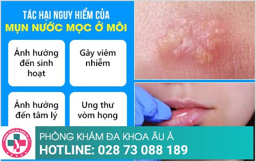 mụn nước ở môi