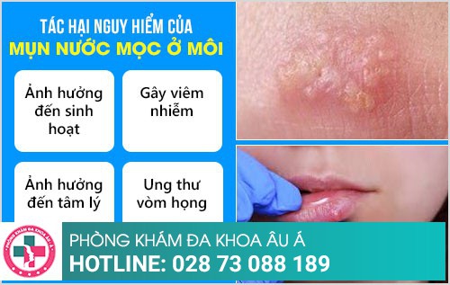 mụn nước ở môi