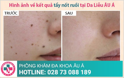 địa chỉ phá nốt ruồi