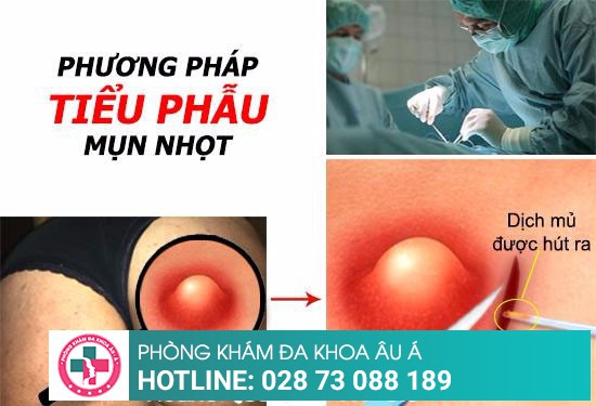 Tiểu phẫu mụn nhọt bằng công nghệ tiên tiến