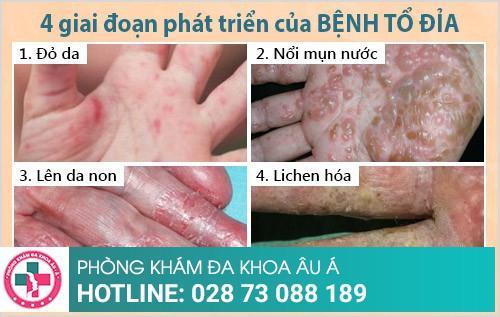 bệnh tổ đỉa