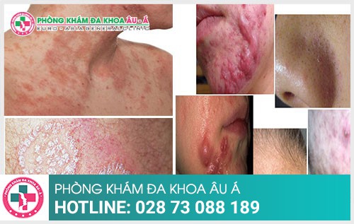trieu-chung-cua-mot-so-benh-da-lieu-thuong-gap