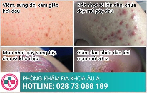 mụn nhọt
