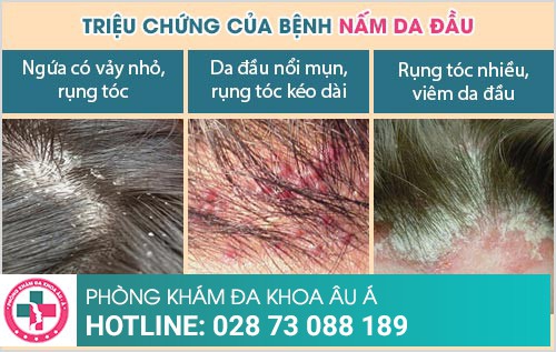 Nấm da đầu cách trị tốt nhất và hiệu quả