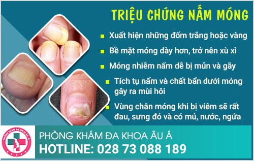 Cách chữa nấm móng tay, chân