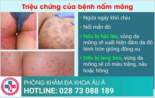 bệnh nấm mông