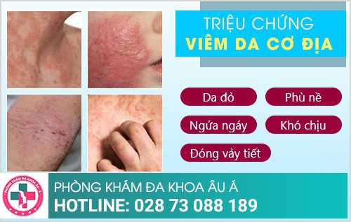 Cảnh giác với bệnh viêm da cơ địa hay gặp