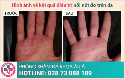 nổi nốt đỏ và ngứa trên da