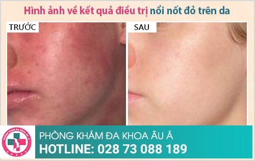 nổi nốt đỏ và ngứa trên da