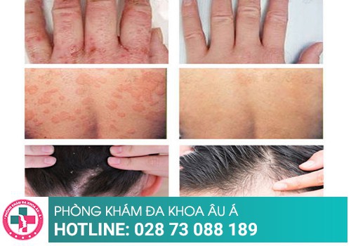 ĐIỀU TRỊ VẢY NẾN 