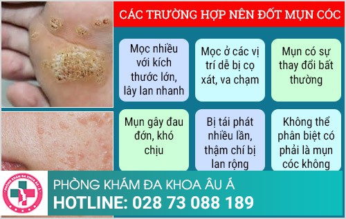 đốt mụn cóc ở đâu