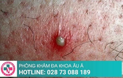 Viêm da mủ cảnh báo nguy hiểm khôn lường