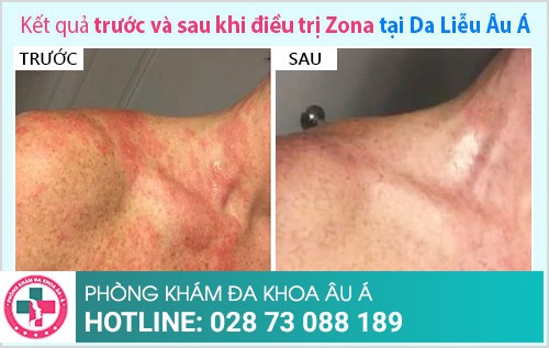 biến chứng zona thần kinh