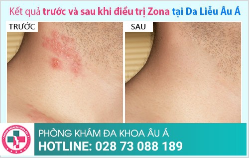 biến chứng zona thần kinh