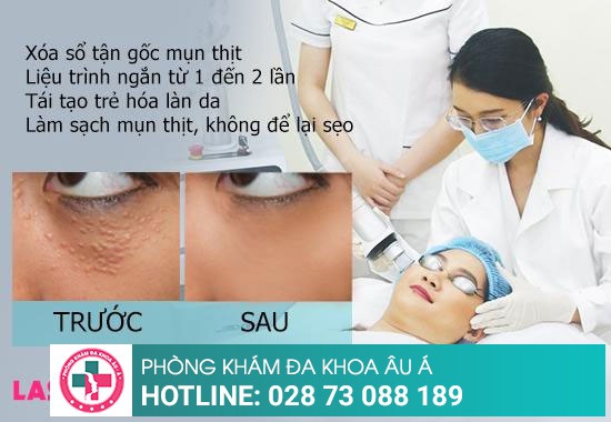 Bắn mụn thịt bằng công nghệ mới Laser CO2 Fractional tiên tiến