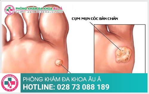 Bạn sẽ không dám tin sự thật bên dưới lớp mụn cóc lòng bàn chân này