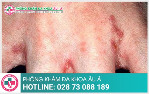 Bệnh ghẻ ngứa - nguyên nhân và cách điều trị hiệu quả