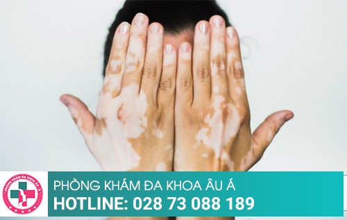 Cách điều trị bệnh bạch biến giúp bệnh nhân lấy lại sự tự tin