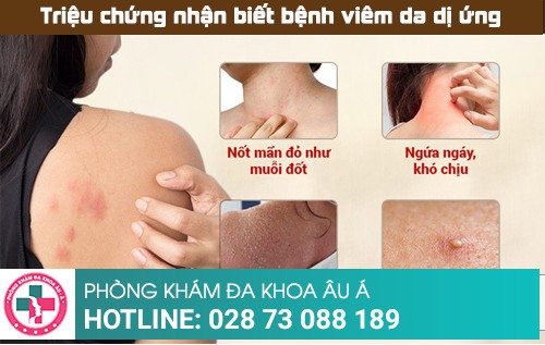 Chữa viêm da dị ứng hiệu quả - nhanh chóng - hạn chế tái phát