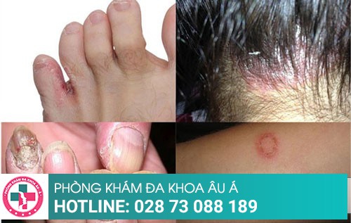 Công nghệ điều trị nấm hiệu quả chỉ sau một liệu trình