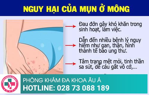 Phương pháp mới trong chữa mụn ở mông tại Da Liễu Âu Á