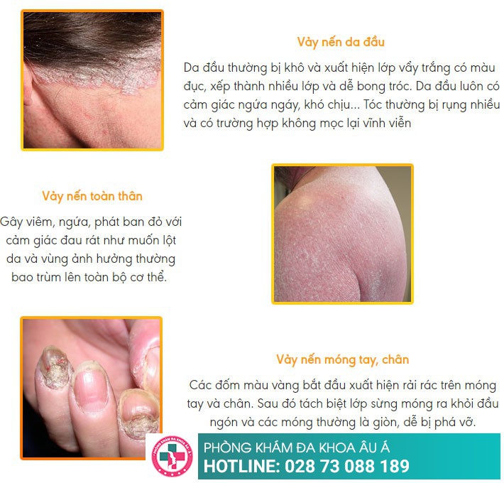 Phương pháp nào hiệu quả để thoát khỏi bệnh vảy nến