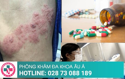 Zona là gì? Nguyên nhân, triệu chứng và cách chữa bệnh